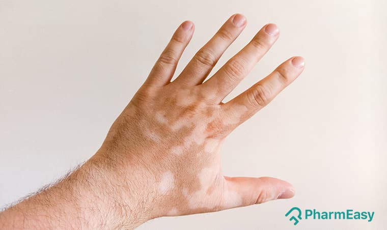 White Patches on Skin: Causes, Symptoms & Home Remedies