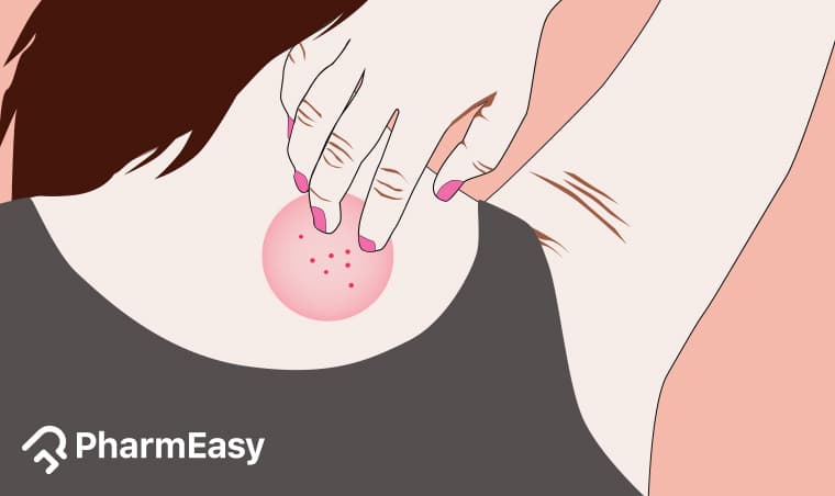 Natural Ringworm Remedies: Home Treatments for Indian Households