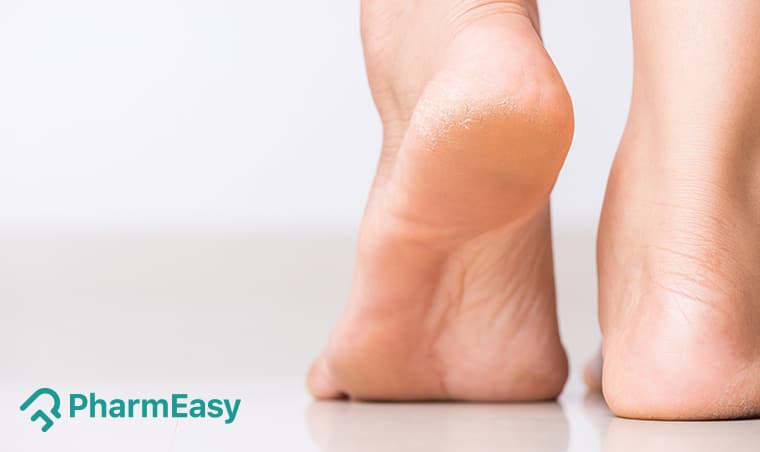 Cracked Heel Home Remedies: Soothe & Heal Dry, Painful Feet