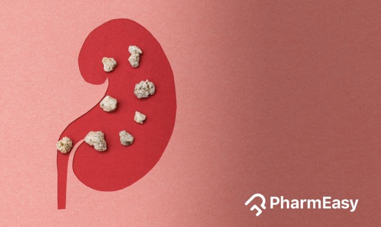 Kidney Stone Home Remedies: Natural Relief by Dr. Siddharth Gupta