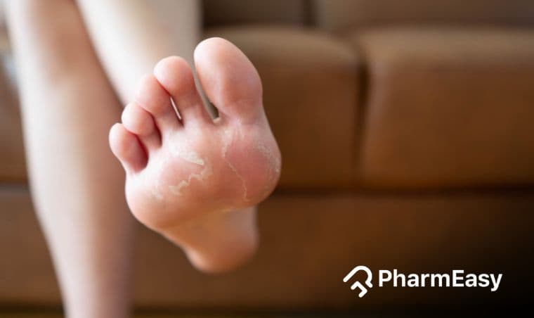 Excessive Sweaty Feet: Causes, Symptoms, and Relief in India