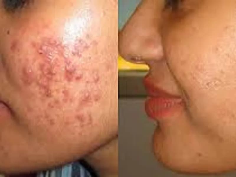 Natural Pimple Treatments: Proven Home Remedies