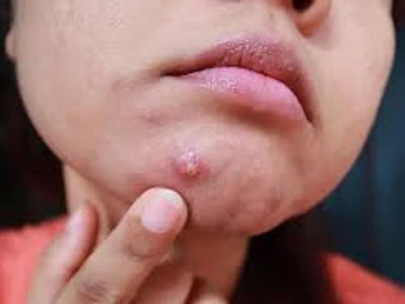 Cystic Acne Treatment: Proven Solutions for Severe Acne