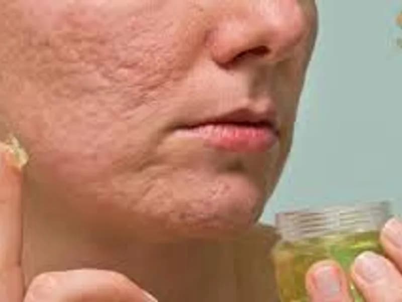 Erase Acne Scars: Expert Treatments & Home Care