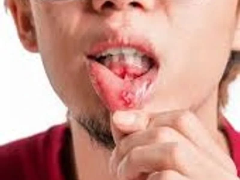 Muh Ka Cancer: 3 Signs You Might Ignore