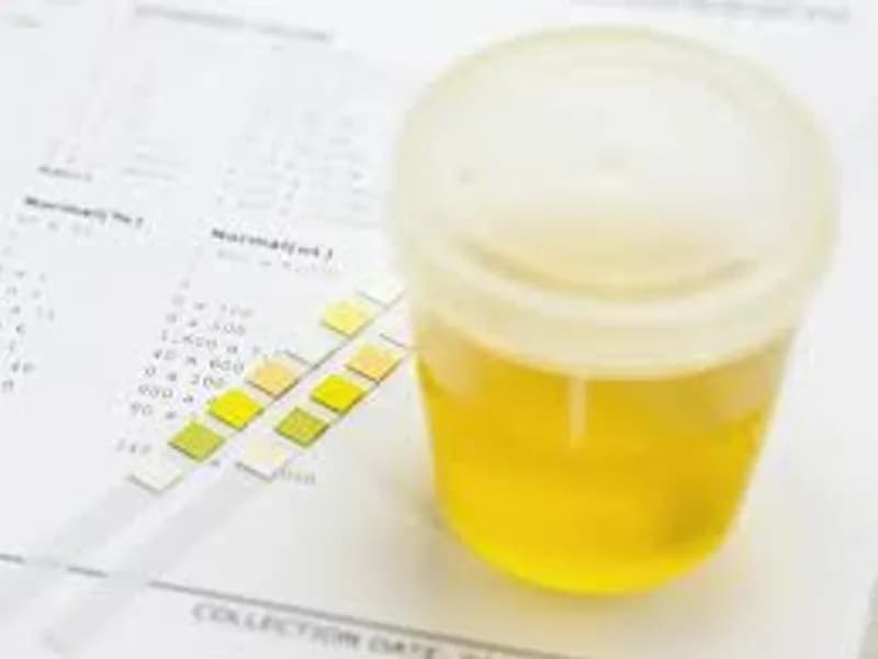 Protein Drain Fluid Test: What You Need to Know