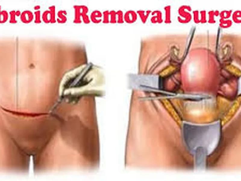 Fibroid Removal Surgery in Kolkata: Expert Guide