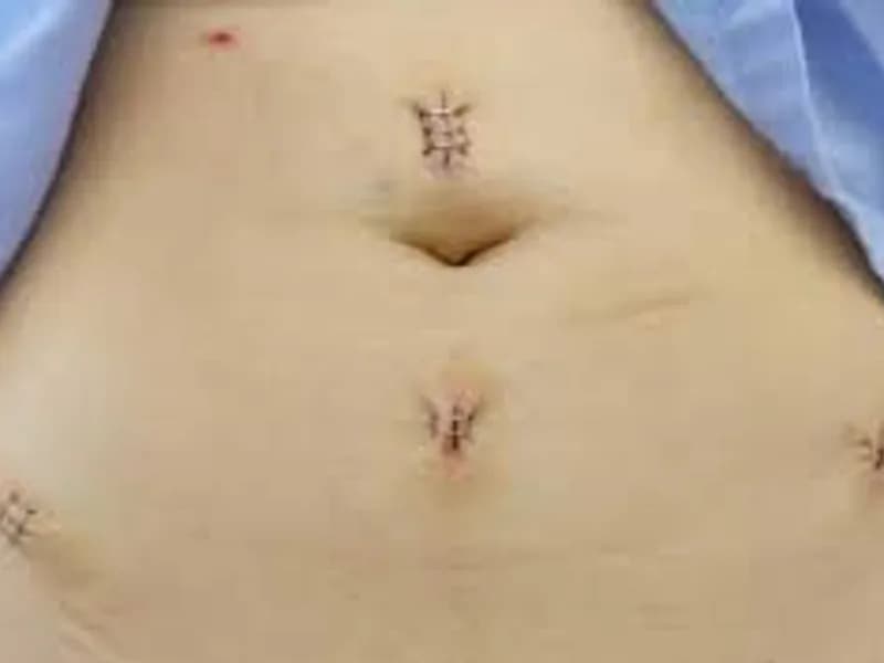 Ovarian Cyst Surgery Kolkata: Expert Care & Options