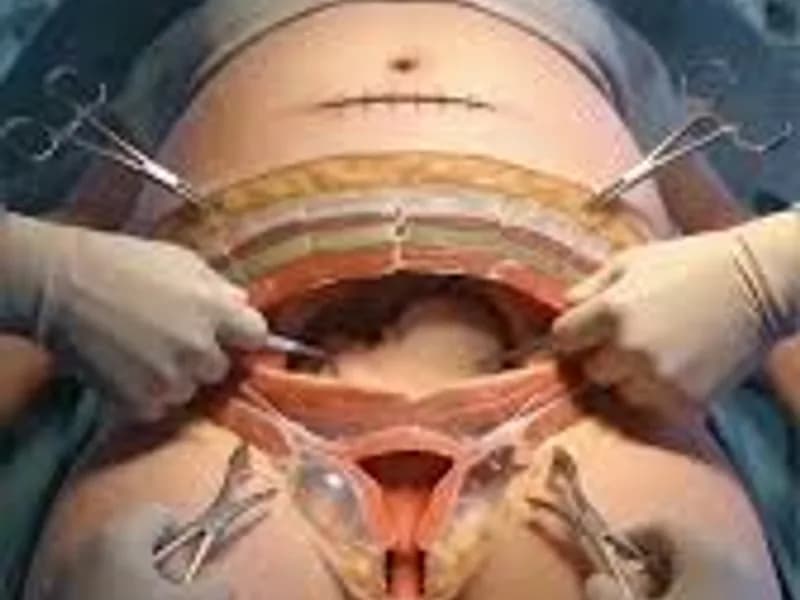 Best Hysterectomy Surgeons in Kolkata: Expert Care & Options