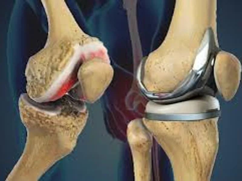 Robotic Knee Replacement Cost India 2026 – Complete india