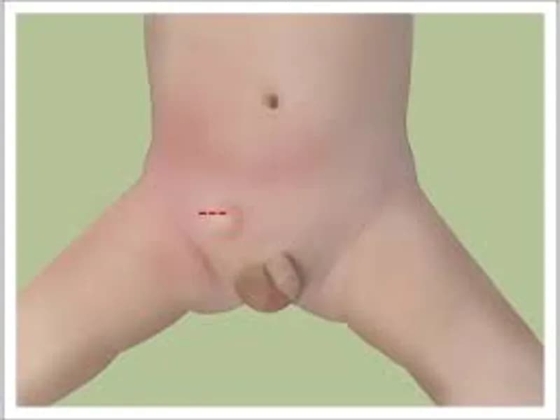 Inguinal Herniotomy (Child Hernia Surgery) in Deoghar 2