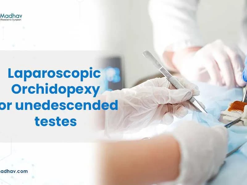 Child Laparoscopic Orchidopexy Surgery in Deoghar