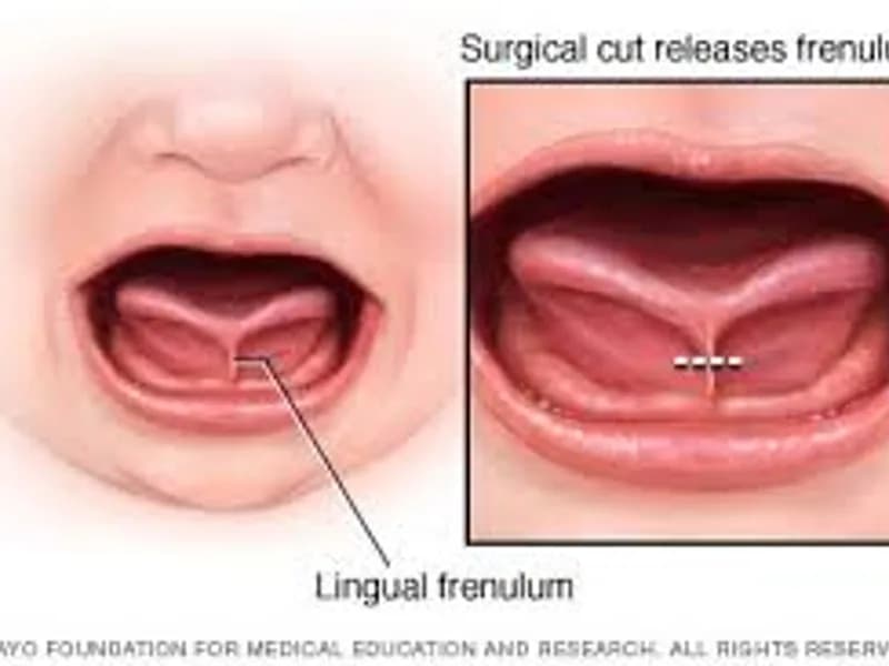 Child Tongue Tie Excision Surgery in Deoghar