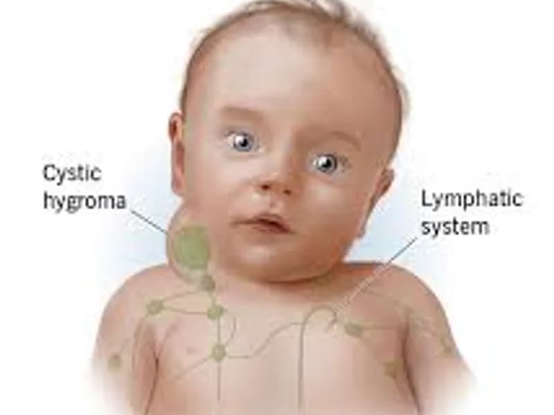 Child Excision of Cystic Hygroma Surgery in Deoghar