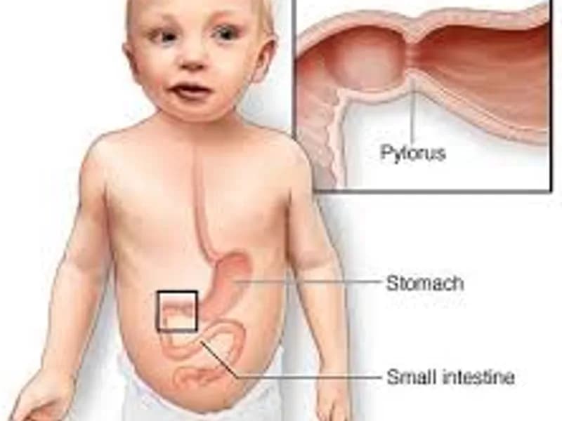 Child congenital pyloric stenosis operation in Deoghar