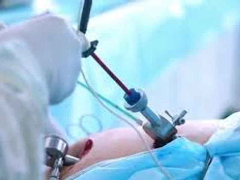 Child hydatid cyst surgery in Deoghar