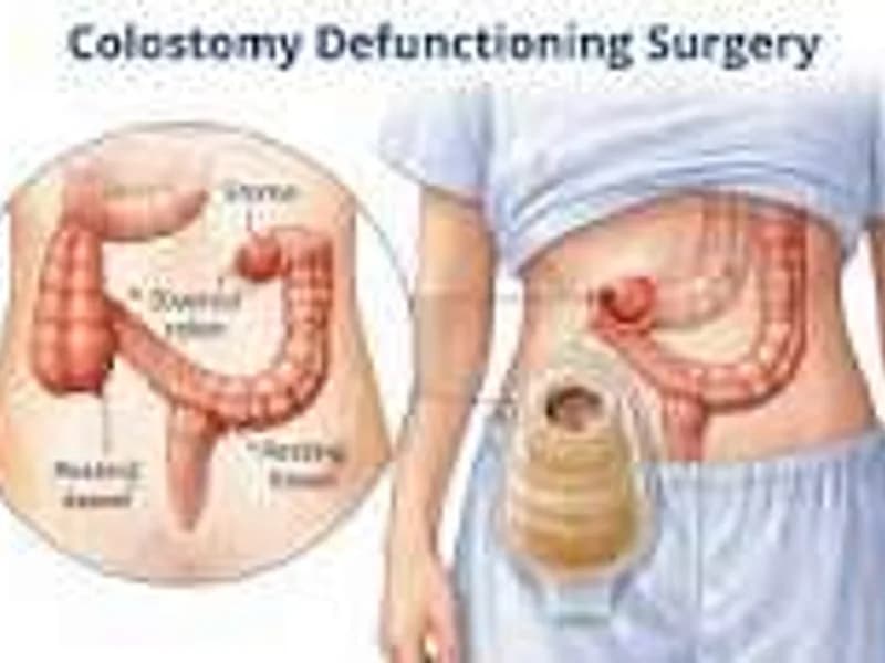 Female Colostomy Surgery in Deoghar