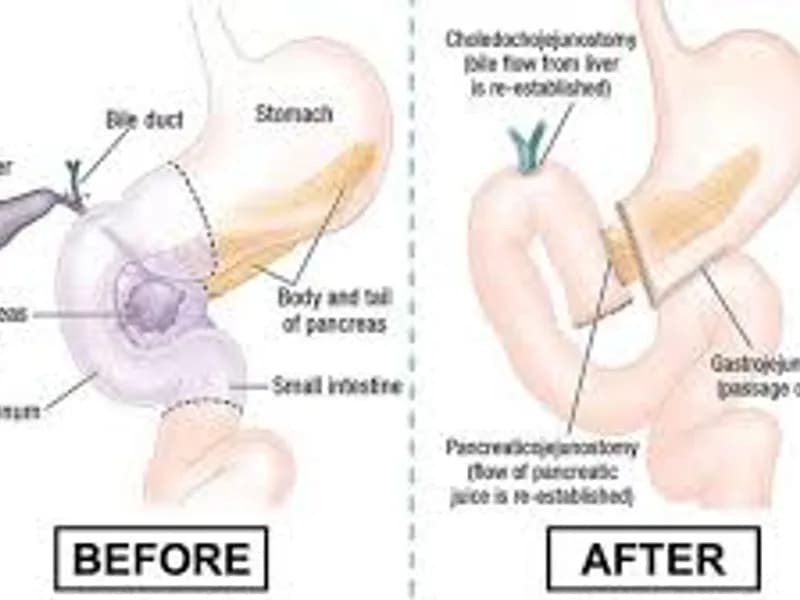 Pancreatic Ring Operation Surgery in Deoghar