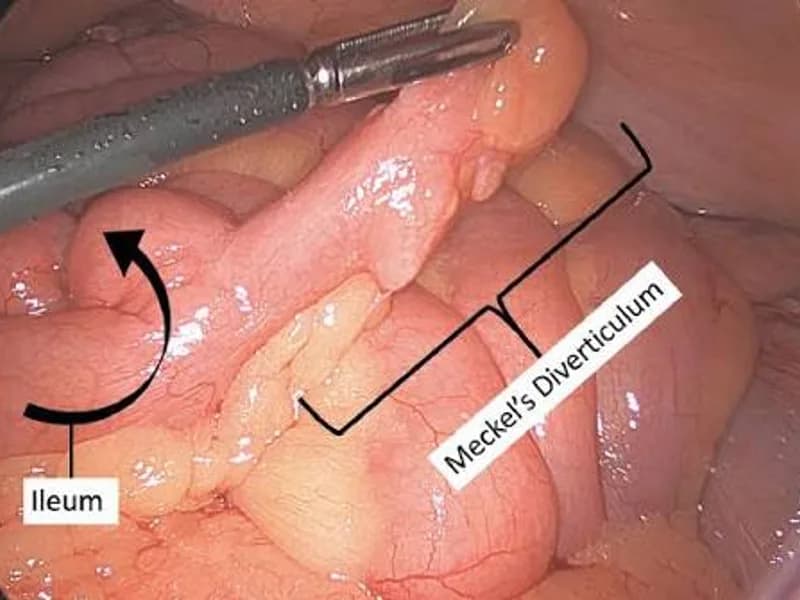 Female Meckel's Diverticulectomy Surgery in Deoghar