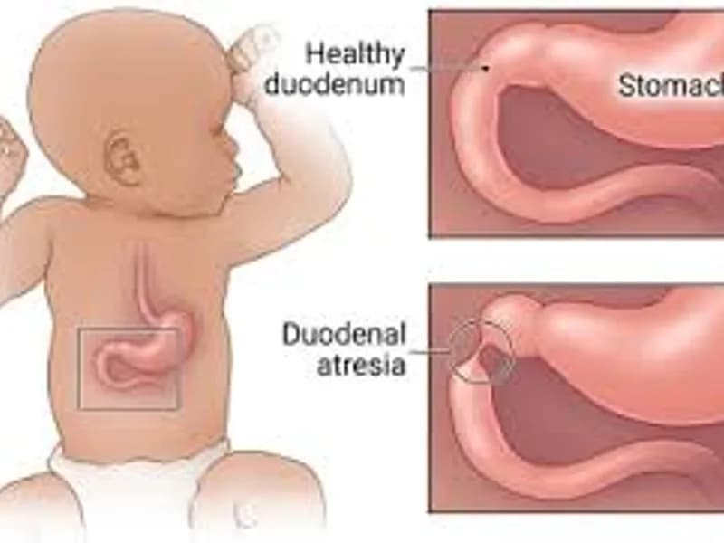 Child Duodenal Atresia Operation Surgery in Deoghar