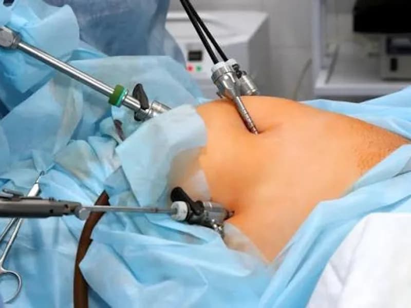 Female Open Appendectomy Surgery in Deoghar