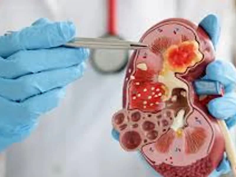 Nephrectomy for Wilms Tumour Surgery in Deoghar