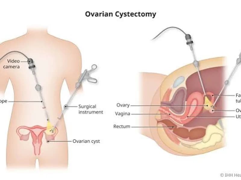 Female Laparoscopic Abdominal Cyst Operation in Deoghar