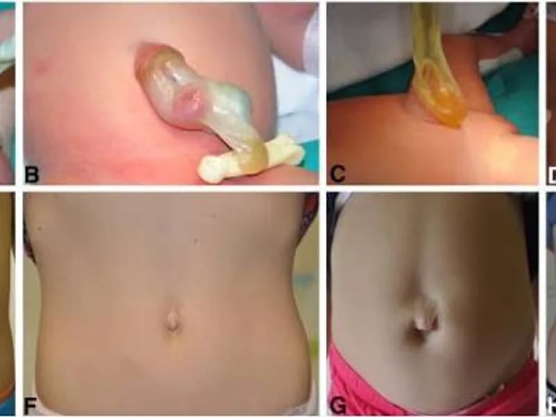 Female Omphalocele First Stage Hernia Repair Surgery in Deoghar