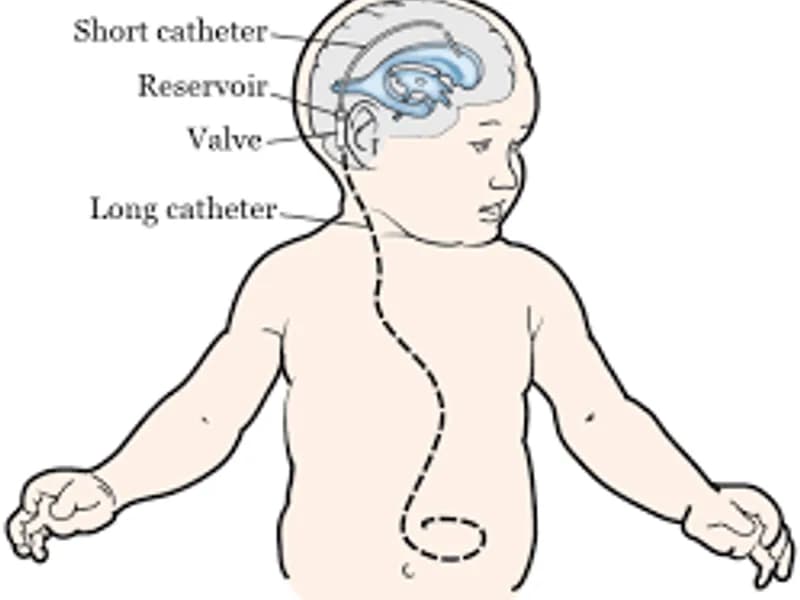 Child VP shunt surgery in Deoghar