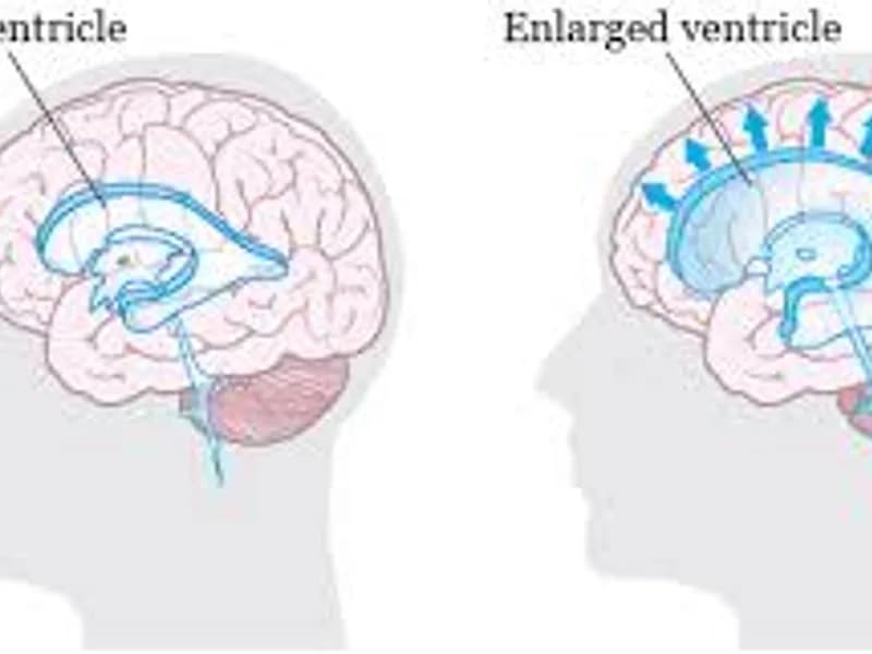 VP Shunt Surgery in Deoghar | Cost, Best Surgeons & Hydrocephalus Treatment