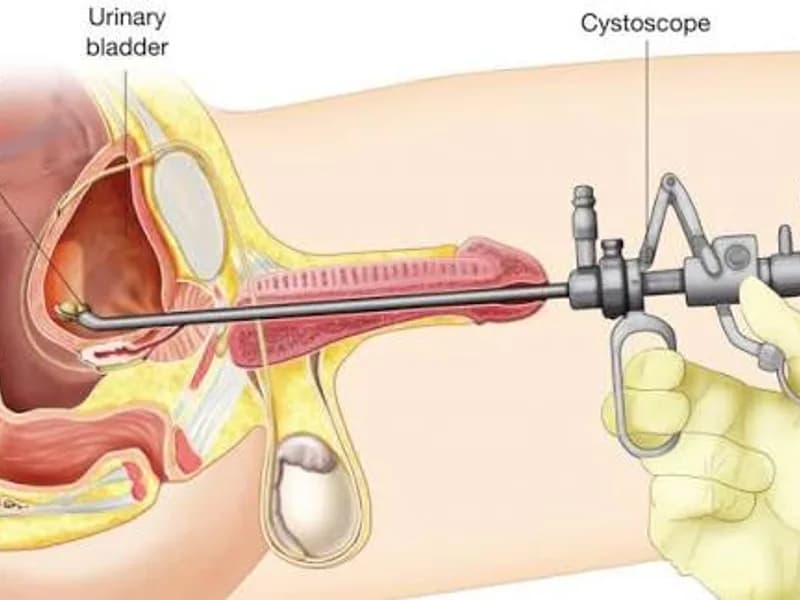 Female Cystolithotomy Surgery in Deoghar