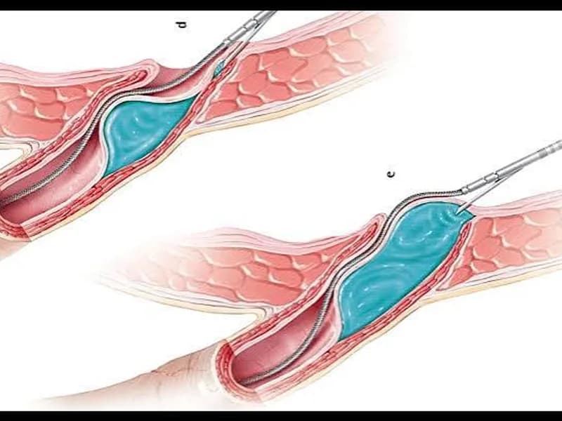 Female Cystoscopic Deflux Injection Surgery in Deoghar