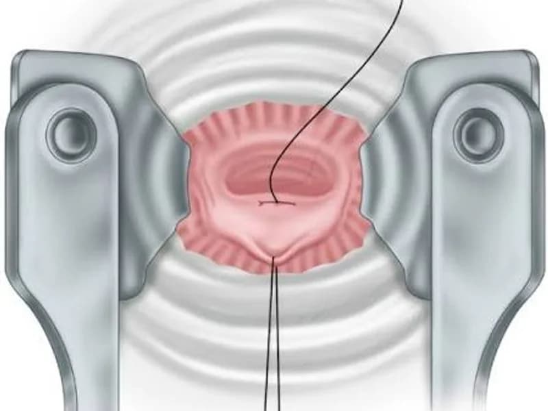Female Rectal Biopsy Surgery in Ranchi