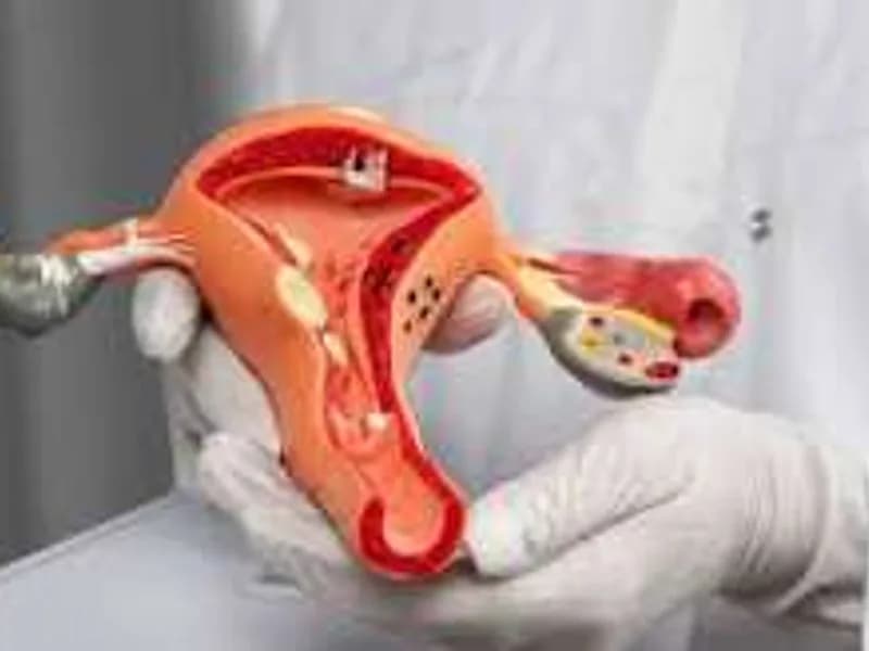 Female Excision of Cyst Surgery in Ranchi