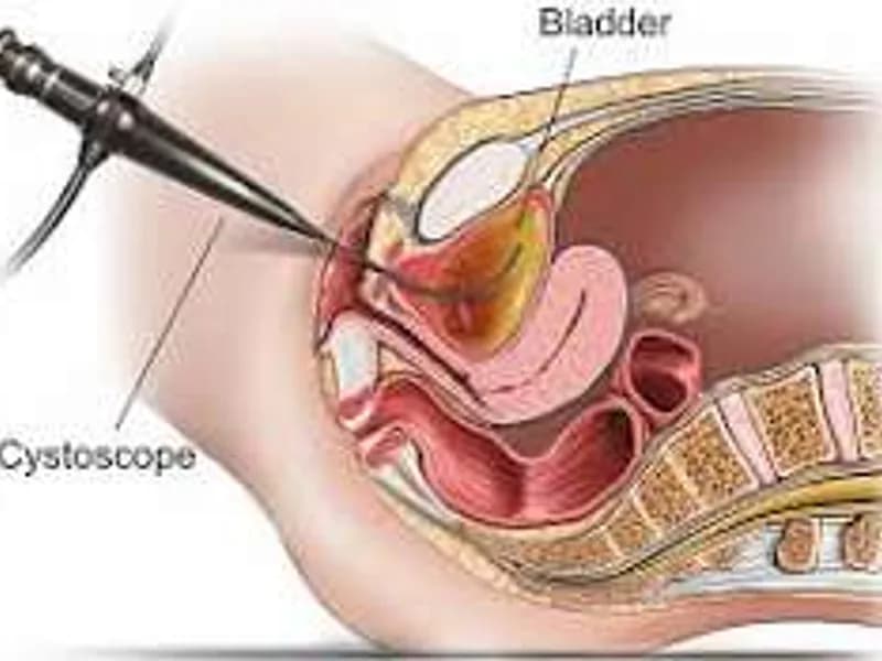 Female Cystoscopy Surgery in Ranchi