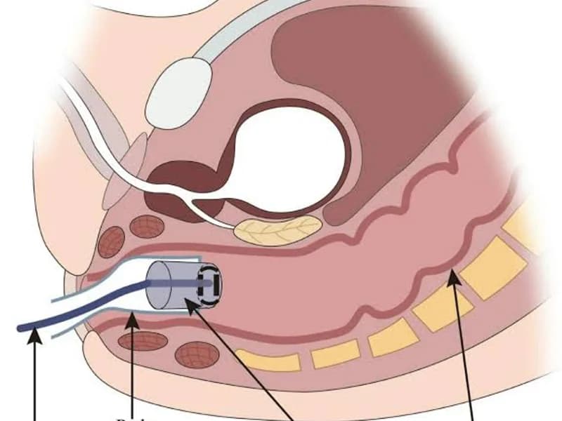 Female Removal of Foreign Body Surgery in Ranchi