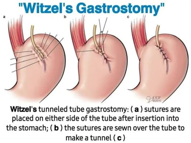 Female Esophagostomy Gastrostomy Surgery in Ranchi