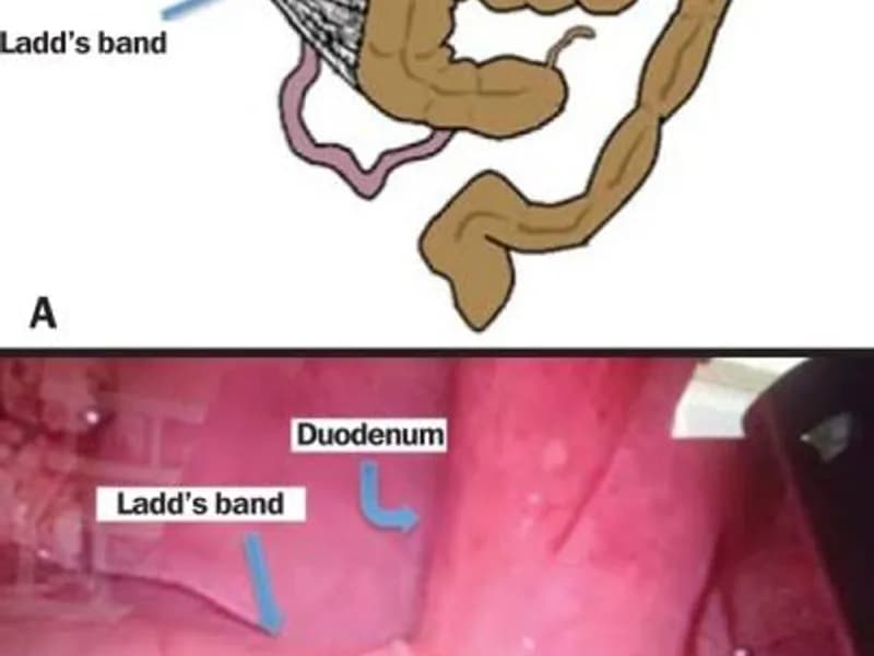Female Malrotation of Gut Surgery in Ranchi