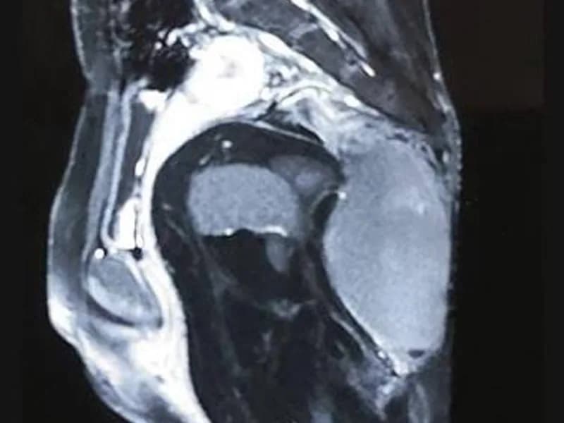 Female Sacrococcygeal Teratoma Excision Surgery in Ranchi