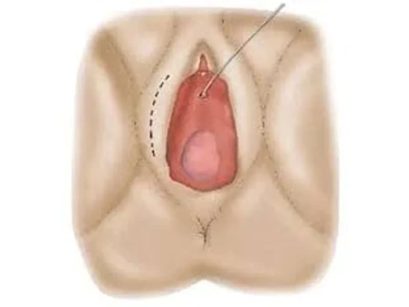 Female Urethroplasty Surgery in Ranchi