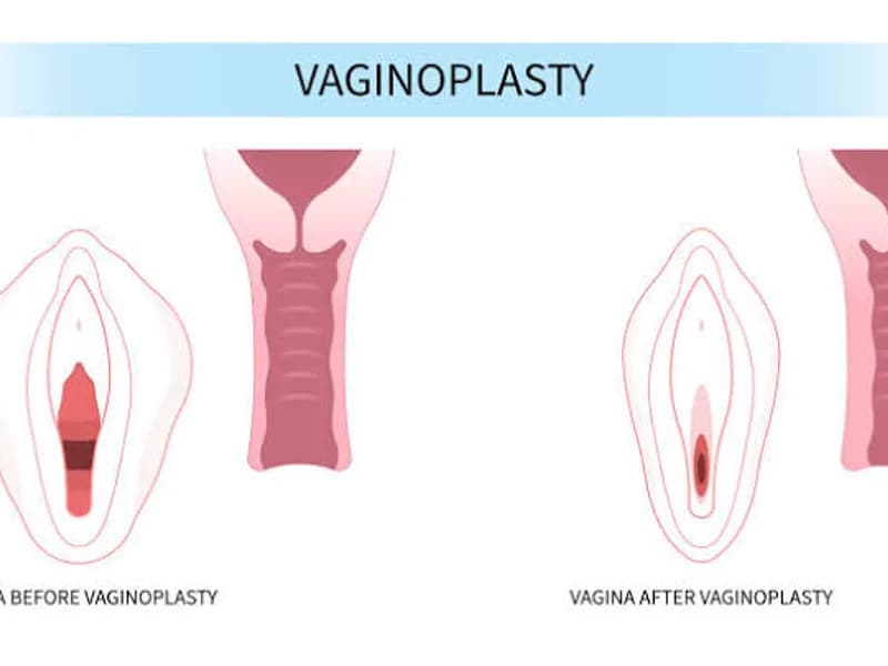 Female Vaginoplasty Reconstruction Surgery in Dhanbad