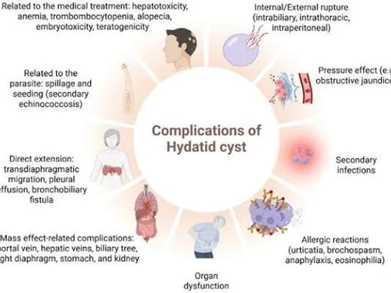 Female Hydatid Cyst Surgery in Dhanbad