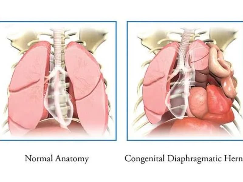 Female Diaphragmatic Hernia Repair Surgery in Dhanbad