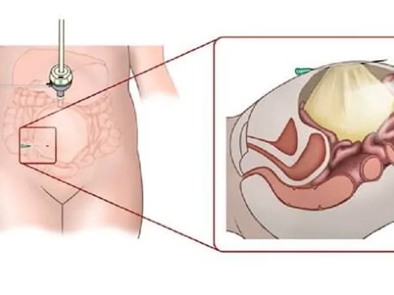 Female Open Abdominal Cyst Operation in Dhanbad