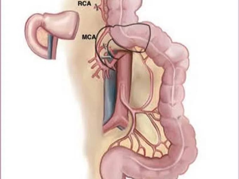 Female Colon Esophagus Replacement Surgery Dhanbad