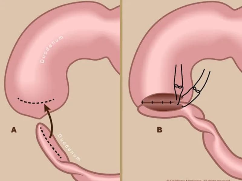 Female Duodenal Atresia Operation Surgery in Dhanbad
