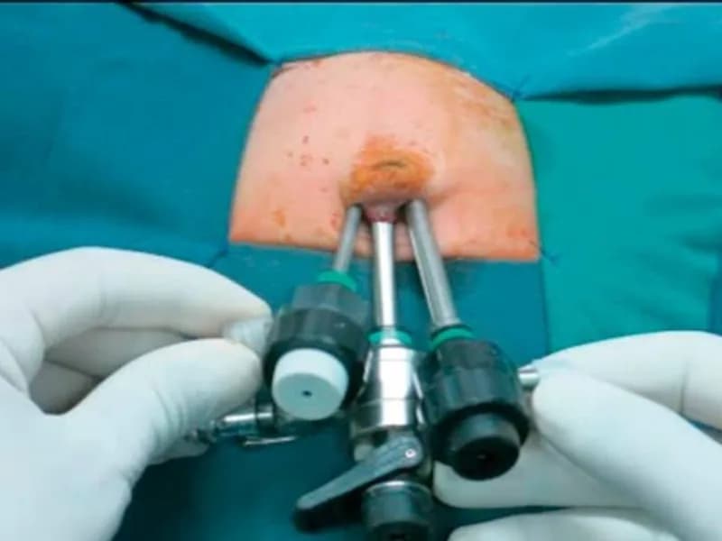 Female Choledochal Cyst Surgery in Dhanbad
