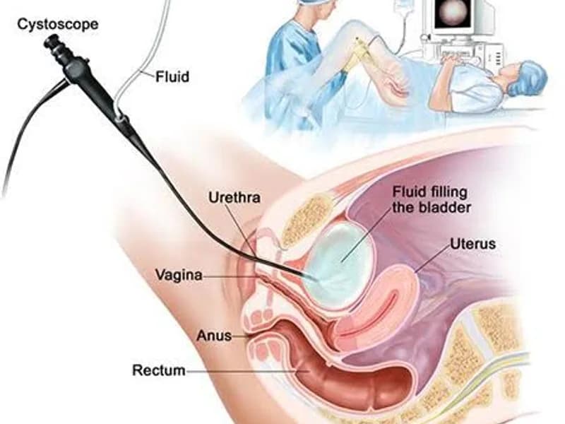 Female Cystoscopic Deroofing Surgery in Dhanbad