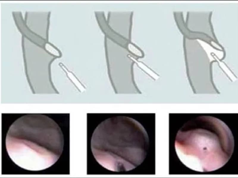 Female Cystoscopic Deflux Injection Surgery in Dhanbad