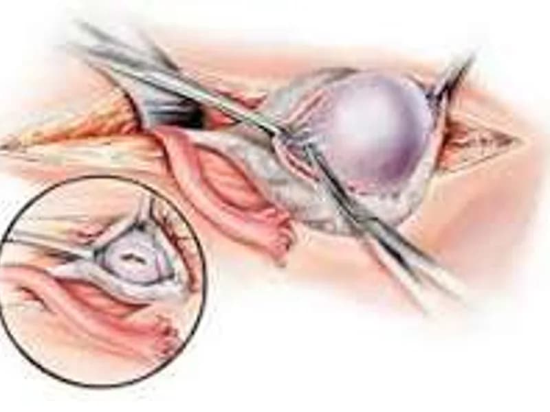 Female Neuroblastoma Debulking Surgery in Dhanbad